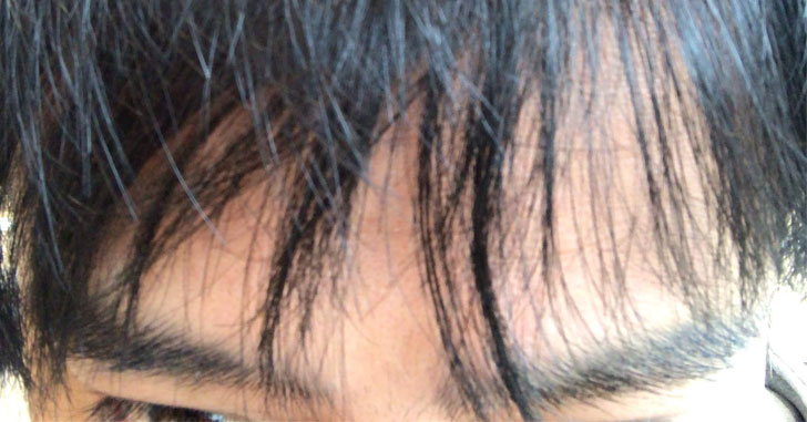 AGA治療は体毛が濃くなる。鼻毛もヒゲもよく伸びるから効いてきた証拠