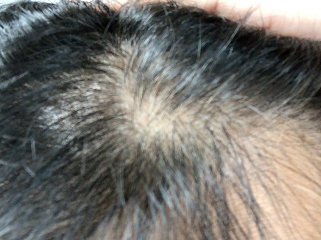 AGA治療薬を飲み始めて3ヶ月程経った時の初期脱毛の様子