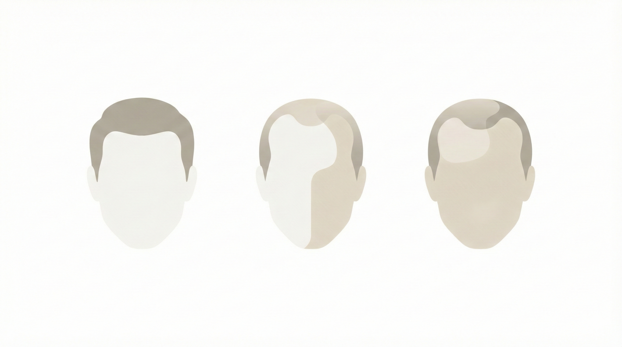 薄毛の出やすい部位を濃淡で示した頭部シルエット図