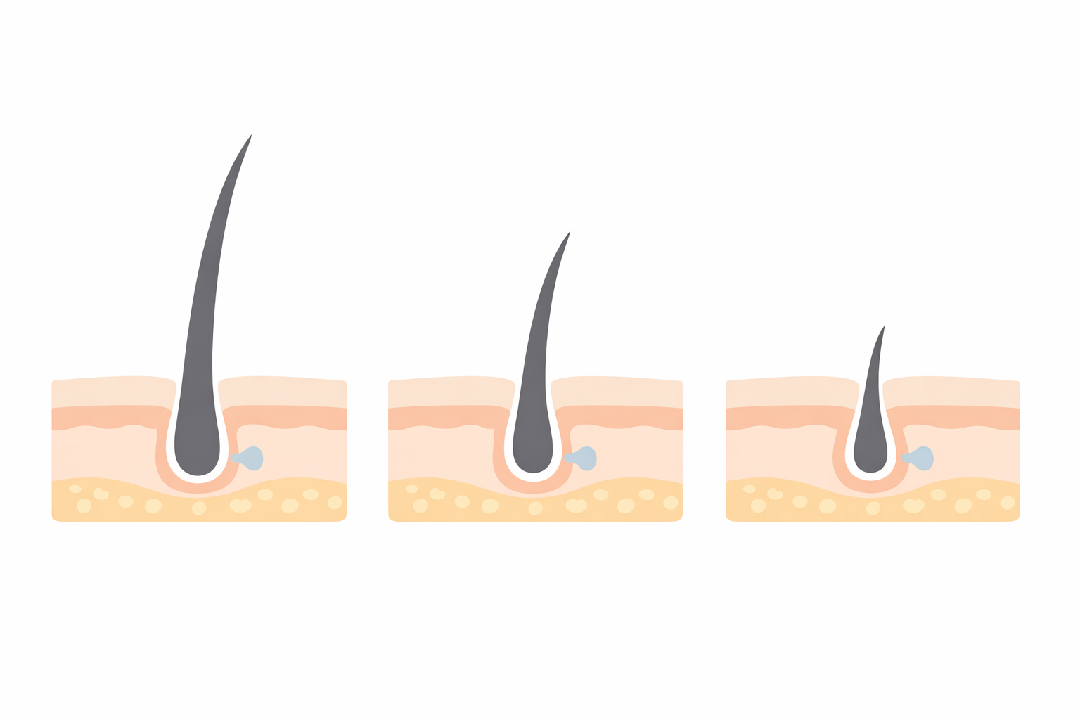 皮膚断面の毛包が並び、太い毛が細く短くなる変化を示したシンプルな図